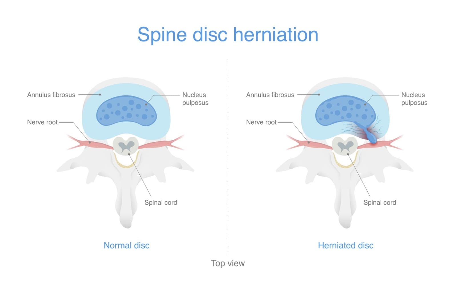 Bulging, Herniated Discs